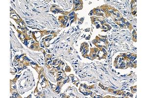 ABIN6258695 and ABIN6273499 at 1/100 staining human pancreatic cancer and adjacent non-tumor tissue by IHC-P. (TAB2 anticorps  (Internal Region))