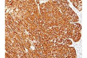 Formalin-fixed, paraffin-embedded human melanoma stained with melanoma Marker antibody (M2-7C10 + M2-9E3 + T311 + HMB45).
