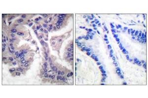 Immunohistochemical analysis of paraffin-embedded human lung carcinoma tissue, using Caspase 6 (cleaved-Asp162) antibody. (Caspase 6 anticorps  (Cleaved-Asp162))