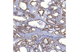 IHC analysis of PIG3/TP53I3 using anti-PIG3/TP53I3 antibody (ABIN7599280). (TP53I3 anticorps  (AA 1-332))