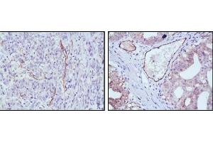 Immunohistochemical analysis of paraffin-embedded human stomach cancer (left) and ovary cancer (right) tissues using eNOS antibody with DAB staining. (ENOS anticorps)