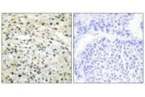 Immunohistochemistry analysis of paraffin-embedded human liver carcinoma tissue using DNMT3B antibody.