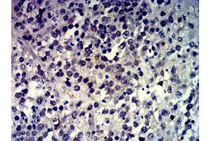 Immunohistochemical analysis of paraffin-embedded brain tumor tissues using MSH6 mouse mAb with DAB staining. (MSH6 anticorps  (AA 374-540))