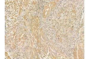 ABIN6262157 and ABIN6273254 at 1/100 staining human tongue carcinoma by IHC-P. (HBS1L anticorps  (N-Term))