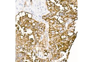 Immunohistochemistry of paraffin-embedded human lung squamous carcinoma tissue using TROP-2 Rabbit mAb (ABIN7271103) at dilution of 1:8100 (40x lens).