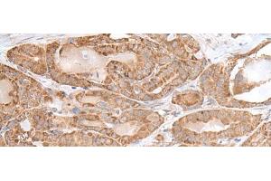 Immunohistochemistry of paraffin-embedded Human thyroid cancer tissue using RPL28 Polyclonal Antibody at dilution of 1:35(x200) (RPL28 anticorps)