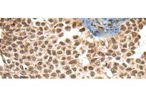 Immunohistochemistry of paraffin-embedded Human ovarian cancer tissue using XPO1 Polyclonal Antibody at dilution of 1:40(x200)