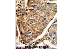 Formalin-fixed and paraffin-embedded human hepatocarcinoma reacted with HEXA Antibody (Center), which was peroxidase-conjugated to the secondary antibody, followed by DAB staining. (Hexosaminidase A anticorps  (AA 315-343))