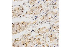 Immunohistochemistry of paraffin-embedded human stomach transfer using DLGAP5 antibody at dilution of 1:200 (x400 lens).