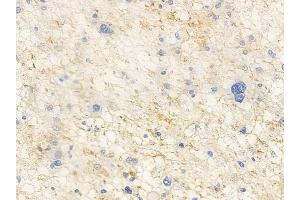 ABIN6265606 and ABIN6266929 at 1/100 staining human astrocytoma by IHC-P. (Anoctamin 7 anticorps  (Internal Region))