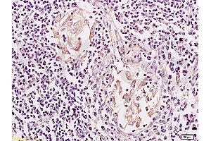 Formalin-fixed and paraffin embedded: human colon carcinoma labeled with Anti-Mesothelin Polyclonal Antibody, Unconjugated (ABIN727608) at 1:200, followed by conjugation to the secondary antibody and DAB staining (Mesothelin anticorps  (AA 101-200))