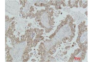 Immunohistochemistry (IHC) analysis of paraffin-embedded Human Lung Carcinoma using MEK-2 Polyclonal Antibody. (MEK2 anticorps)