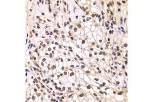 Immunohistochemistry of paraffin-embedded human kidney cancer using SMARCC1 antibody. (SMARCC1 anticorps)