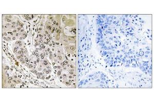 Immunohistochemistry analysis of paraffin-embedded human lung carcinoma tissue, using STK36 antibody. (STK36 anticorps  (Internal Region))