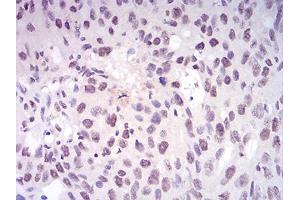 Immunohistochemical analysis of paraffin-embedded ovarian cancer tissues using DNMT1 mouse mAb with DAB staining.