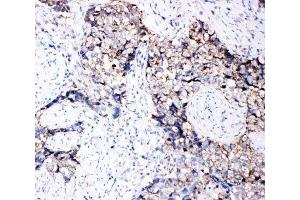 IHC-P: EphB3 antibody testing of human lung cancer tissue (EPH Receptor B3 anticorps  (C-Term))