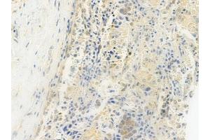 ABIN6264684 and ABIN6279171 at 1/100 staining human lung squamous cell carcinoma by IHC-P. (RECQL4 anticorps  (Internal Region))