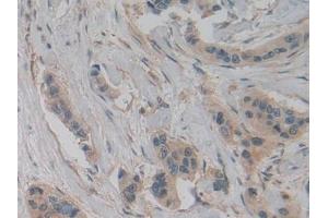 Detection of PKM2 in Human Breast cancer Tissue using Polyclonal Antibody to Pyruvate kinase isozymes M2 (PKM2)