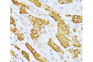 Immunohistochemistry of paraffin-embedded Human liver cancer using CYP2E1 Polyclonal Antibody at dilution of 1:100 (40x lens). (CYP2E1 anticorps)
