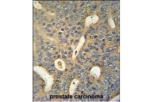 MICALL1 Antibody (C-term) (ABIN654455 and ABIN2844189) immunohistochemistry analysis in formalin fixed and paraffin embedded human prostate carcinoma followed by peroxidase conjugation of the secondary antibody and DAB staining. (MICAL-Like 1 anticorps  (C-Term))