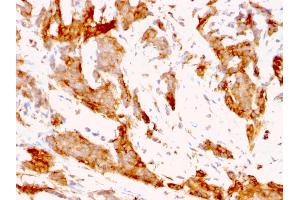 Formalin-fixed, paraffin-embedded human Breast Carcinoma stained with GRP94 Rat Monoclonal Antibody (9G10.
