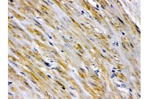 FABP2/I-FABP was detected in paraffin-embedded sections of human intestinal cancer tissues using rabbit anti- FABP2/I-FABP Antigen Affinity purified polyclonal antibody (Catalog # ) at 1 ?