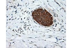 Immunohistochemical staining of paraffin-embedded Adenocarcinoma of colon tissue using anti-SRR mouse monoclonal antibody. (SRR anticorps)