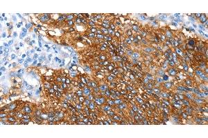 Immunohistochemistry of paraffin-embedded Human lung cancer using SNX5 Polyclonal Antibody at dilution of 1:30 (SNX5 anticorps)
