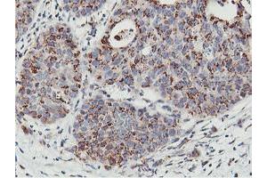 Immunohistochemical staining of paraffin-embedded Carcinoma of Human lung tissue using anti-NMT2 mouse monoclonal antibody. (NMT2 anticorps)
