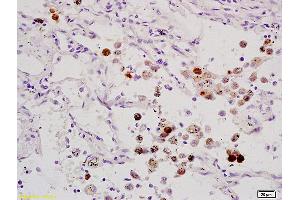 Formalin-fixed and paraffin embedded human lung carcinoma labeled with Anti-ELK1 Polyclonal Antibody, Unconjugated (ABIN685972) at 1:200 followed by conjugation to the secondary antibody and DAB staining. (ELK1 anticorps  (AA 301-428))