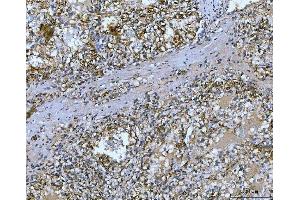 IHC analysis of Carbonic Anhydrase 9/CA9 using anti-Carbonic Anhydrase 9/CA9 antibody (ABIN7600076). (CA9 anticorps  (AA 146-414))