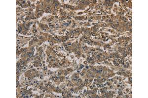 Immunohistochemistry of Human liver cancer using KRT16 Polyclonal Antibody at dilution of 1:30 (KRT16 anticorps)