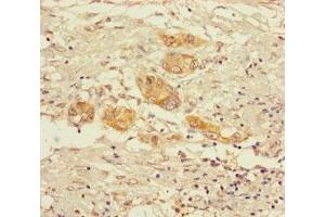 Immunohistochemistry of paraffin-embedded human pancreatic cancer using ABIN7142162 at dilution of 1:100 (alpha KGDHC anticorps  (AA 41-423))