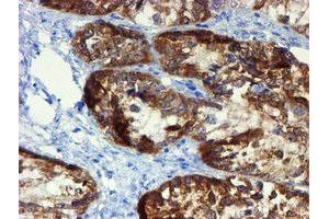 Immunohistochemical staining of paraffin-embedded Adenocarcinoma of Human ovary tissue using anti-DOK7 mouse monoclonal antibody. (DOK7 anticorps)