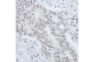 Immunohistochemistry of paraffin-embedded human colon carcinoma using XRCC1 Rabbit pAb (ABIN1683300, ABIN5663662, ABIN5663663, ABIN5663664 and ABIN6213850) at dilution of 1:300 (40x lens).
