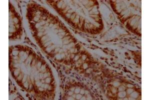 IHC image of ABIN7127591 diluted at 1:100 and staining in paraffin-embedded human colon cancer performed on a Leica BondTM system.