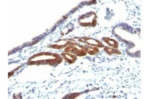 Formalin-fixed, paraffin-embedded human Gastric Carcinoma stained with MUC6 Monoclonal Antibody (SPM598). (MUC6 anticorps)