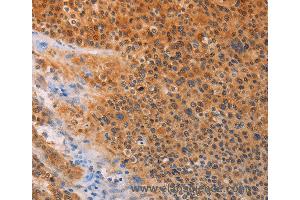 Immunohistochemistry of Human lung cancer using ADHFE1 Polyclonal Antibody at dilution of 1:30 (ADHFE1 anticorps)
