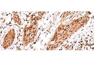 Immunohistochemistry of paraffin-embedded Human esophagus cancer tissue using AK9 Polyclonal Antibody at dilution of 1:60(x200) (Adenylate Kinase 9 anticorps)