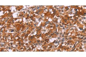 Immunohistochemistry of paraffin-embedded Human thyroid cancer tissue using HSPB6 Polyclonal Antibody at dilution 1:30