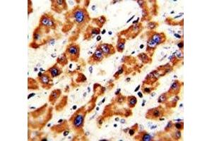 IHC analysis of FFPE human hepatocarcinoma with Prohibitin antibody