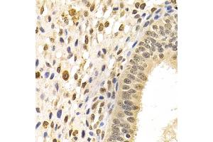 Immunohistochemistry of paraffin-embedded human uterine cancer using DNMT3A Antibody (ABIN1872325) at dilution of 1:100 (40x lens). (DNMT3A anticorps)