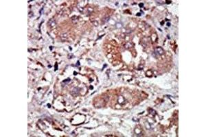 IHC analysis of FFPE human hepatocarcinoma stained with the PRKR antibody (EIF2AK2 anticorps  (AA 519-550))