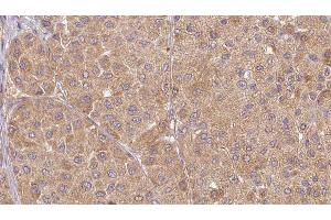 ABIN6277525 at 1/100 staining Human Melanoma tissue by IHC-P. (Urotensin 2 anticorps  (C-Term))