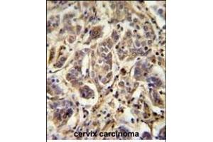 FL Antibody (C-term) (ABIN651674 and ABIN2840355) immunohistochemistry analysis in formalin fixed and paraffin embedded human cervix carcinoma followed by peroxidase conjugation of the secondary antibody and DAB staining. (AAGAB anticorps  (C-Term))