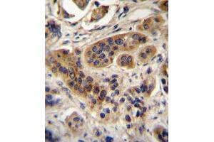 ACOX1 Antibody (N-term) A immunohistochemistry analysis in formalin fixed and paraffin embedded human bladder carcinoma followed by peroxidase conjugation of the secondary antibody and DAB staining. (ACOX1 anticorps  (N-Term))