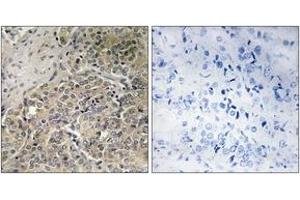 Immunohistochemistry analysis of paraffin-embedded human prostate carcinoma, using A26C2/3 Antibody. (A26C2/3 (AA 401-450) anticorps)