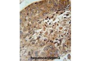 ACD10 Antibody (Center) immunohistochemistry analysis in formalin fixed and paraffin embedded human hepatocarcinoma followed by peroxidase conjugation of the secondary antibody and DAB staining.