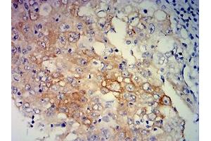 Immunohistochemical analysis of paraffin-embedded lung cancer tissues using ERCC1 mouse mAb with DAB staining.