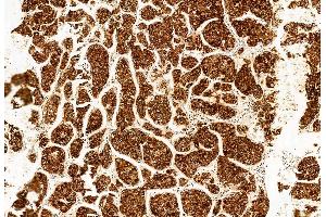 ABIN6260141 and ABIN6272955 at 1/100 staining Human liver cancer by IHC-P.